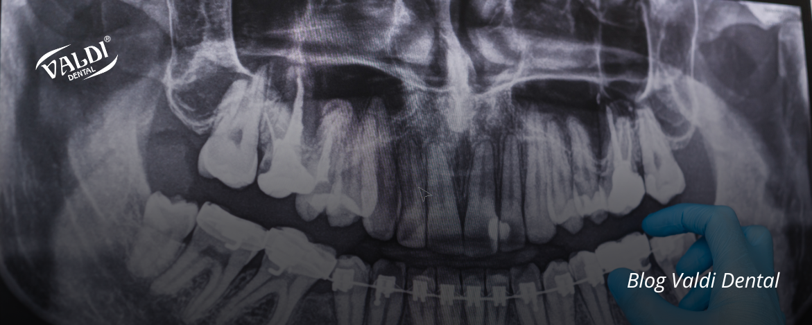 Acetatos dentales: materiales esenciales para tratamientos odontológicos modernos